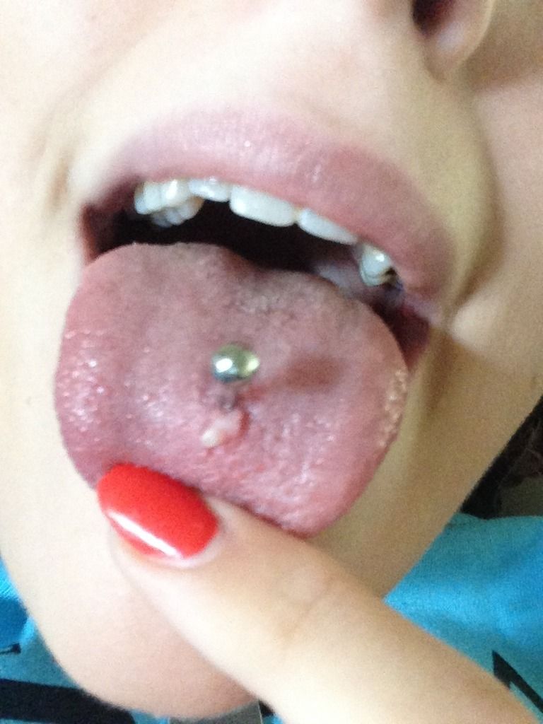 "White bump on tongue piercing that is over a year old": Oral Health