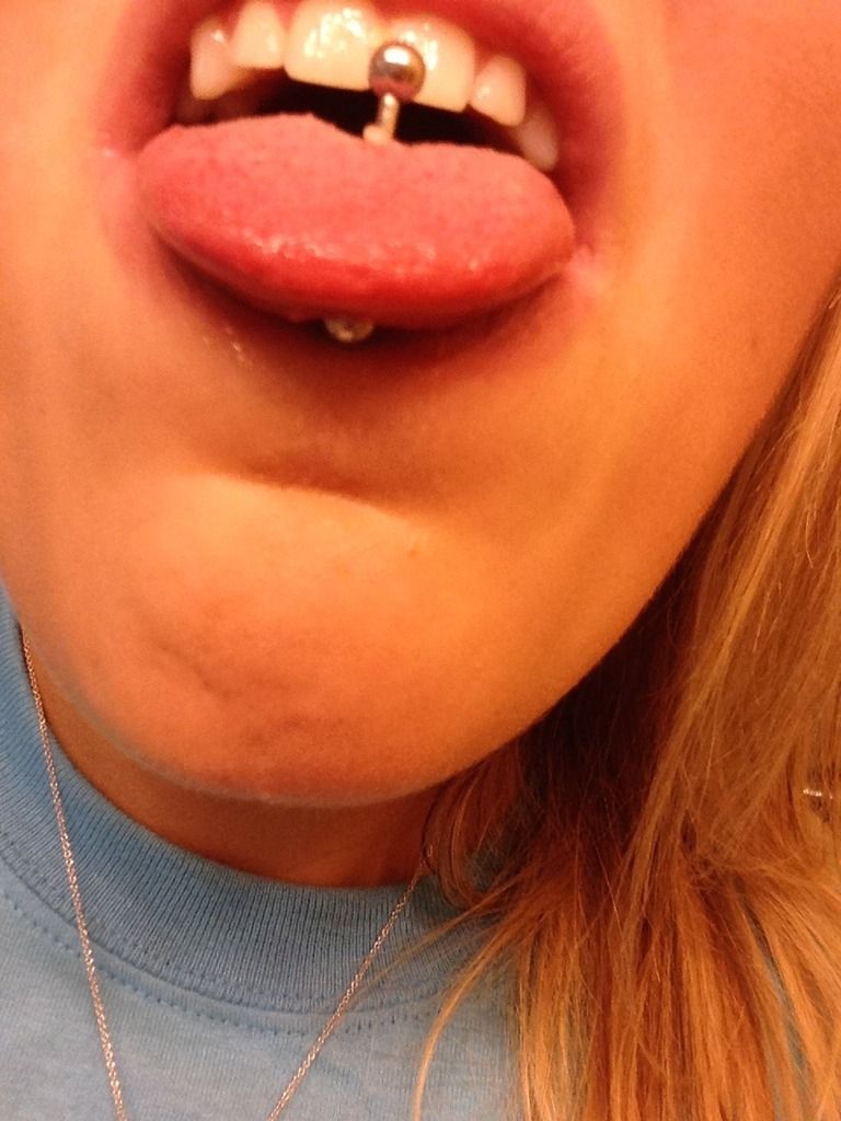  White Bump On Tongue Piercing That Is Over A Year Old Oral Health 